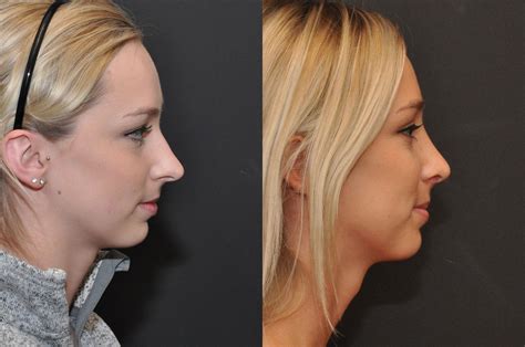 Nose Reshaping Surgery .